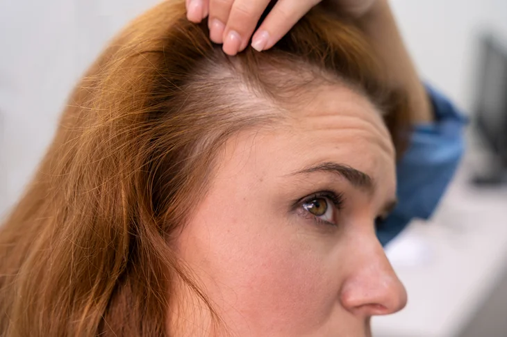 androgenic-alopecia-how-trichologist-diagnoses-treats
