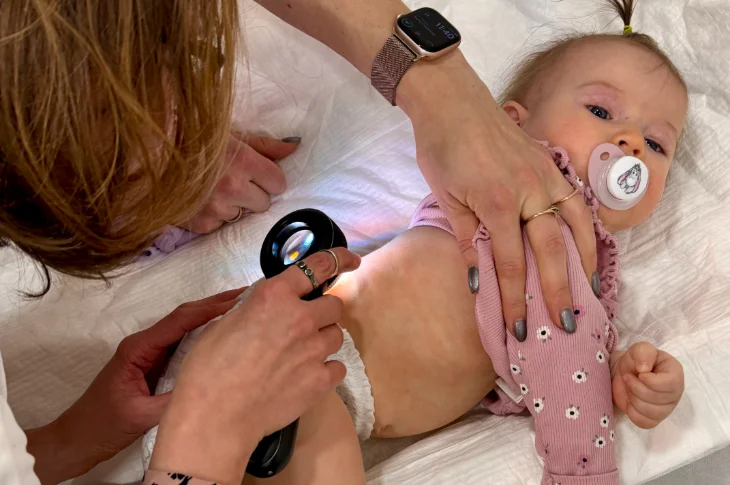 Atopic Dermatitis Child: How Recognize Treat?