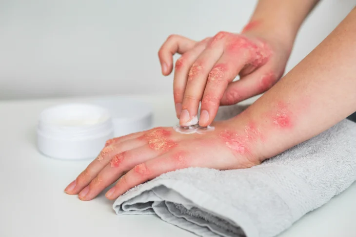 Atopic Dermatitis Child: How Recognize Treat?