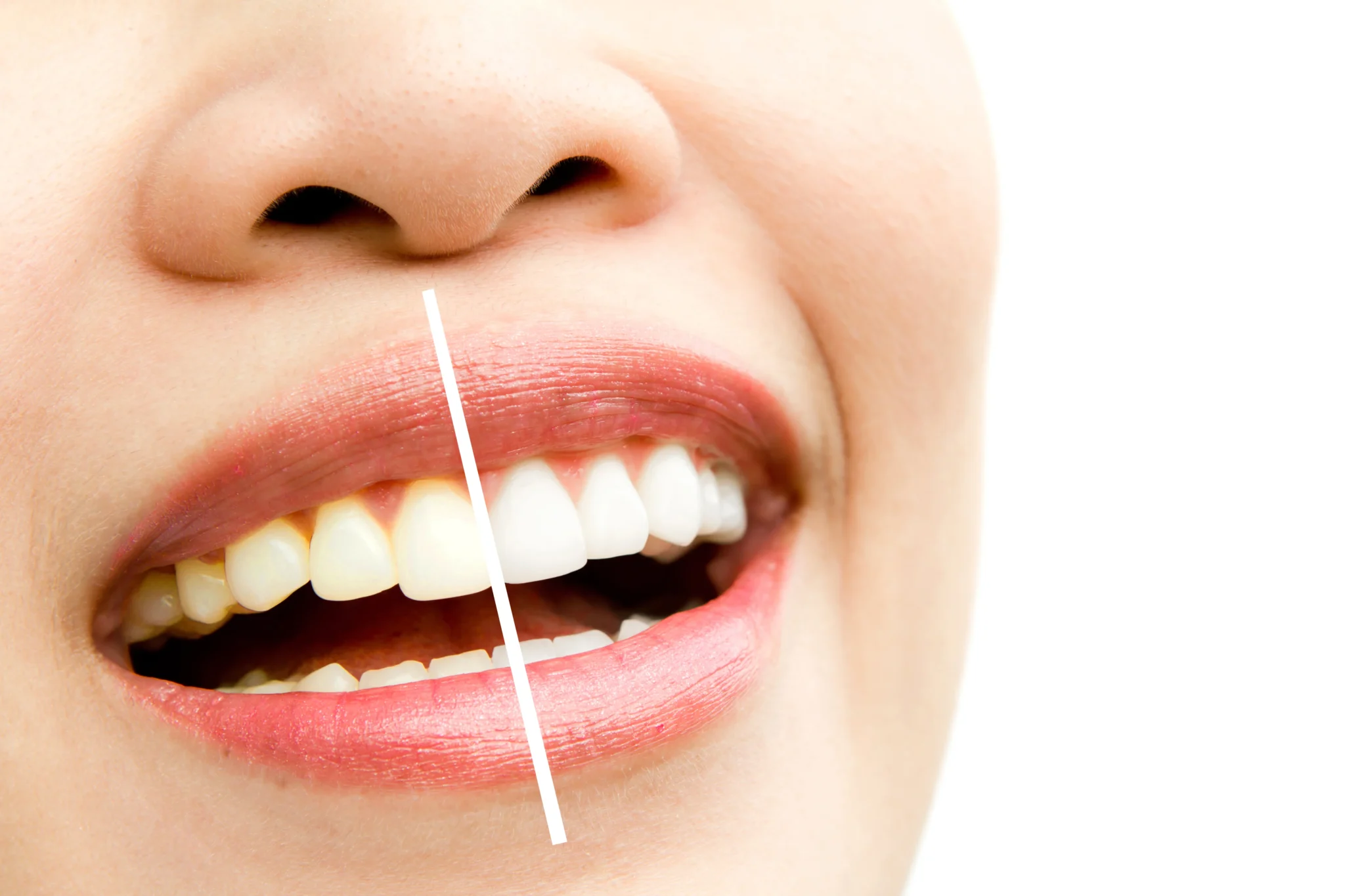 Natural Methods for Teeth Whitening: Do They Work?