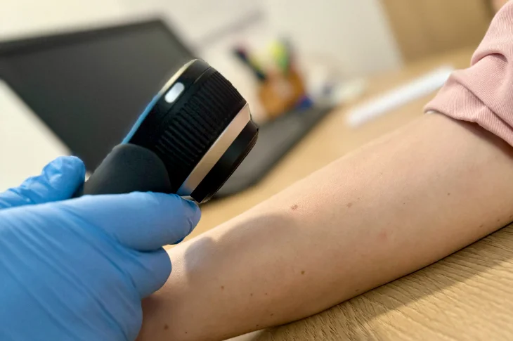 Moles Skin Formations: When Need Check?