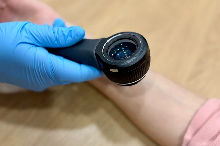 How Mole Check with Dermatoscope Done?