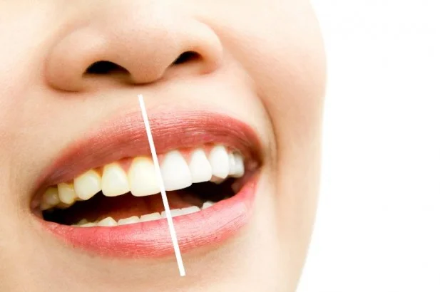 Teeth Whitening with ZOOM Technology